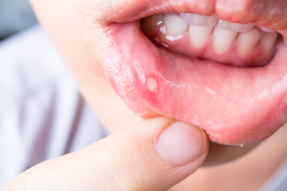 a woman holds down her lower lip showing a mouth ulcer