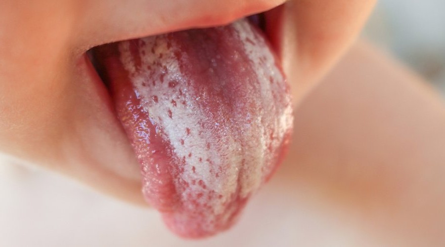 candidiasis oral