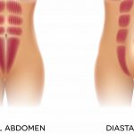 diastasis recti scaled e1613648033750