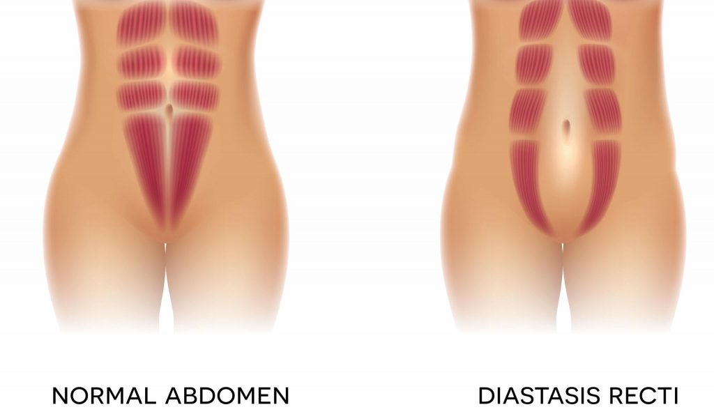 diastasis recti scaled e1613648033750 scaled