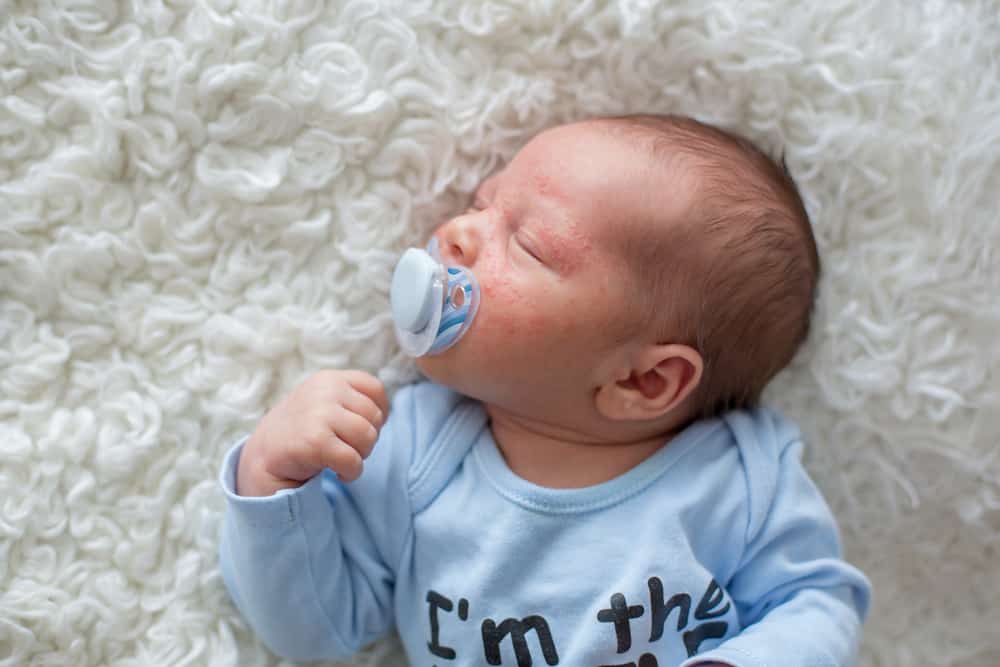 does my baby have acne1